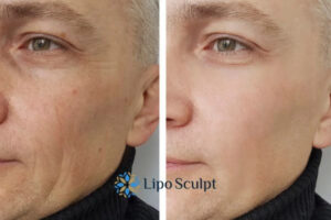 How to Fight Aging Symptoms 3 Fight Aging Symptoms Ross on Wye With HIFU and Morpheus8 Today!