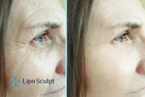 How to Fight Aging Symptoms 2 Do you want to Fight Aging Symptoms Ross on Wye? Contact Lipo Sculpt today!