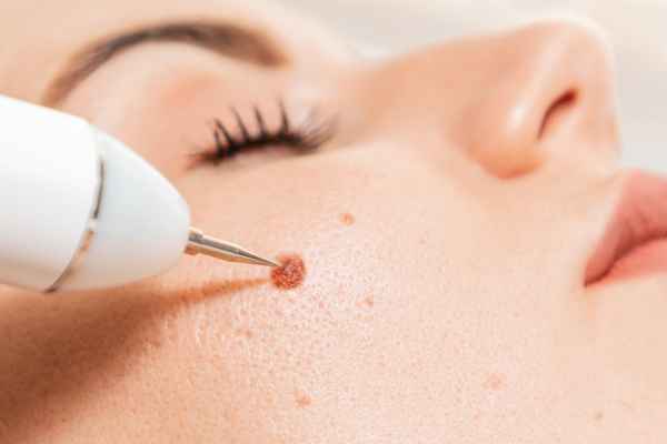 CryoPen: 5 Skin Concerns It May Be Used to Treat 3 What actually happens during a CryoPen treatment Ross on Wye?