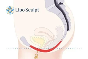 Pelvic Floor Chair Therapy 1 Pelvic Floor Chair Therapy Ross on Wye to treat incontinence.