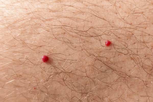 CryoPen: 5 Skin Concerns It May Be Used to Treat 2 cherry angioma removal Ross on Wye