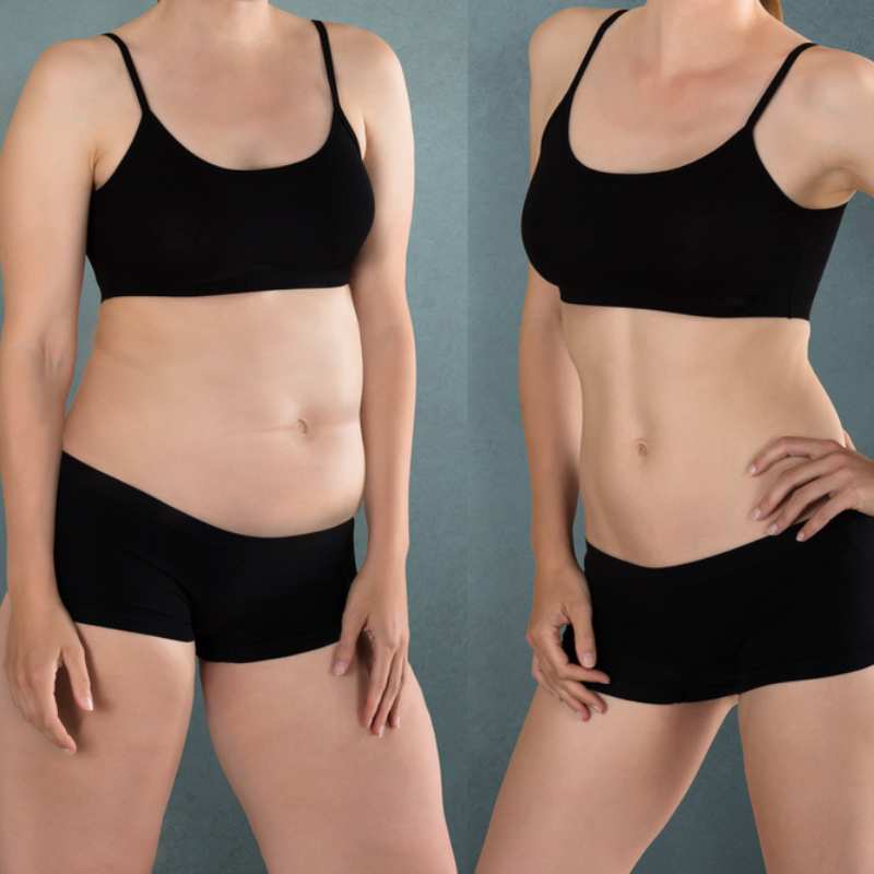 Does Fat Freezing at Home Work? DIY Devices vs Professional Cryolipolysis 2 before and after Cryolipolysis Ross on Wye