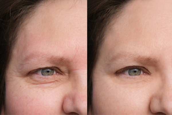 HIFU vs Botulinum Toxin: Understanding the Differences 4 How long do HIFU results last Ross on Wye?