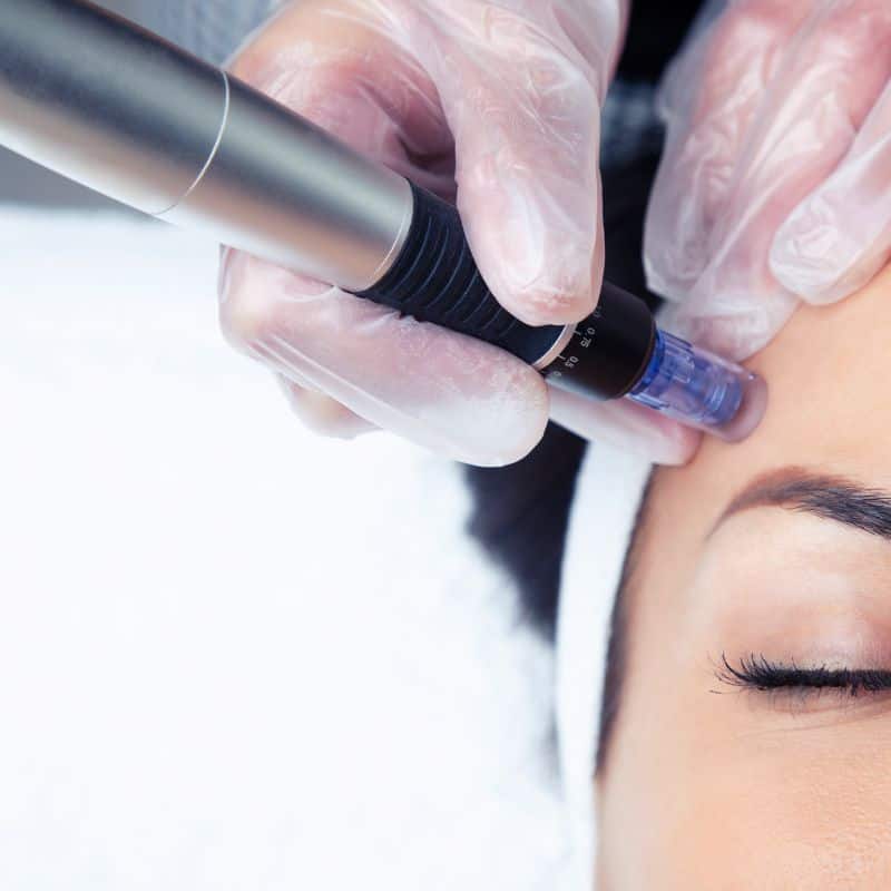 Morpheus8 treatment Ross on Wye from Lipo Sculpt - Book in today!
