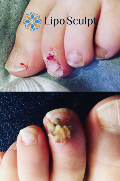 Wart removal customer results from Lipo Sculpt Ross on Wye