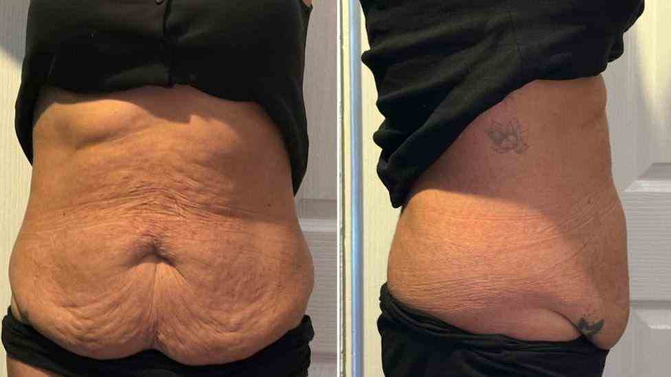 Lost the Weight but Not the Loose Skin? What You Should Know 1 Is It Definitely Loose Skin Ross on Wye?